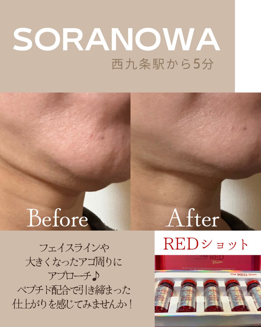 新入荷！フェイシャルをスッキリ♪『REDショット』