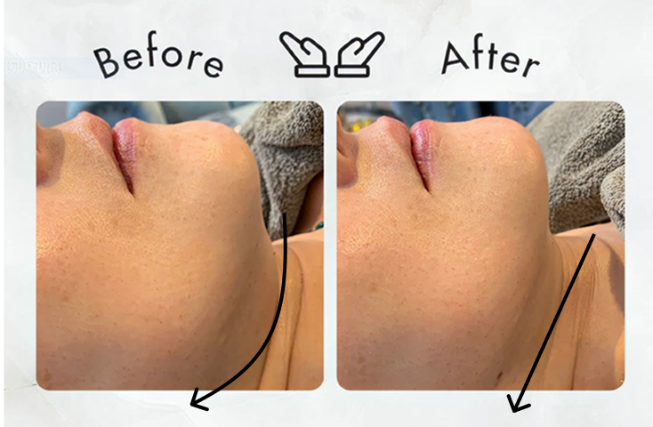 Before After フェイシャルエステの施術前後の写真１