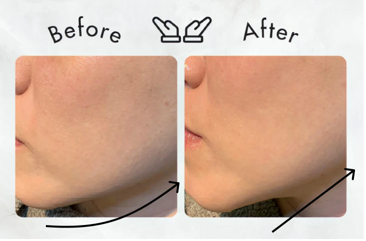 Before After フェイシャルエステの施術前後の写真２