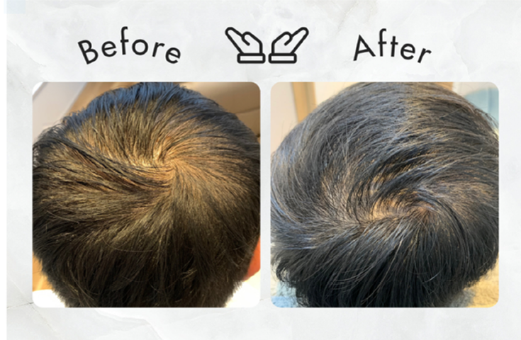 Before After 頭皮スカルプケアの施術前後の写真