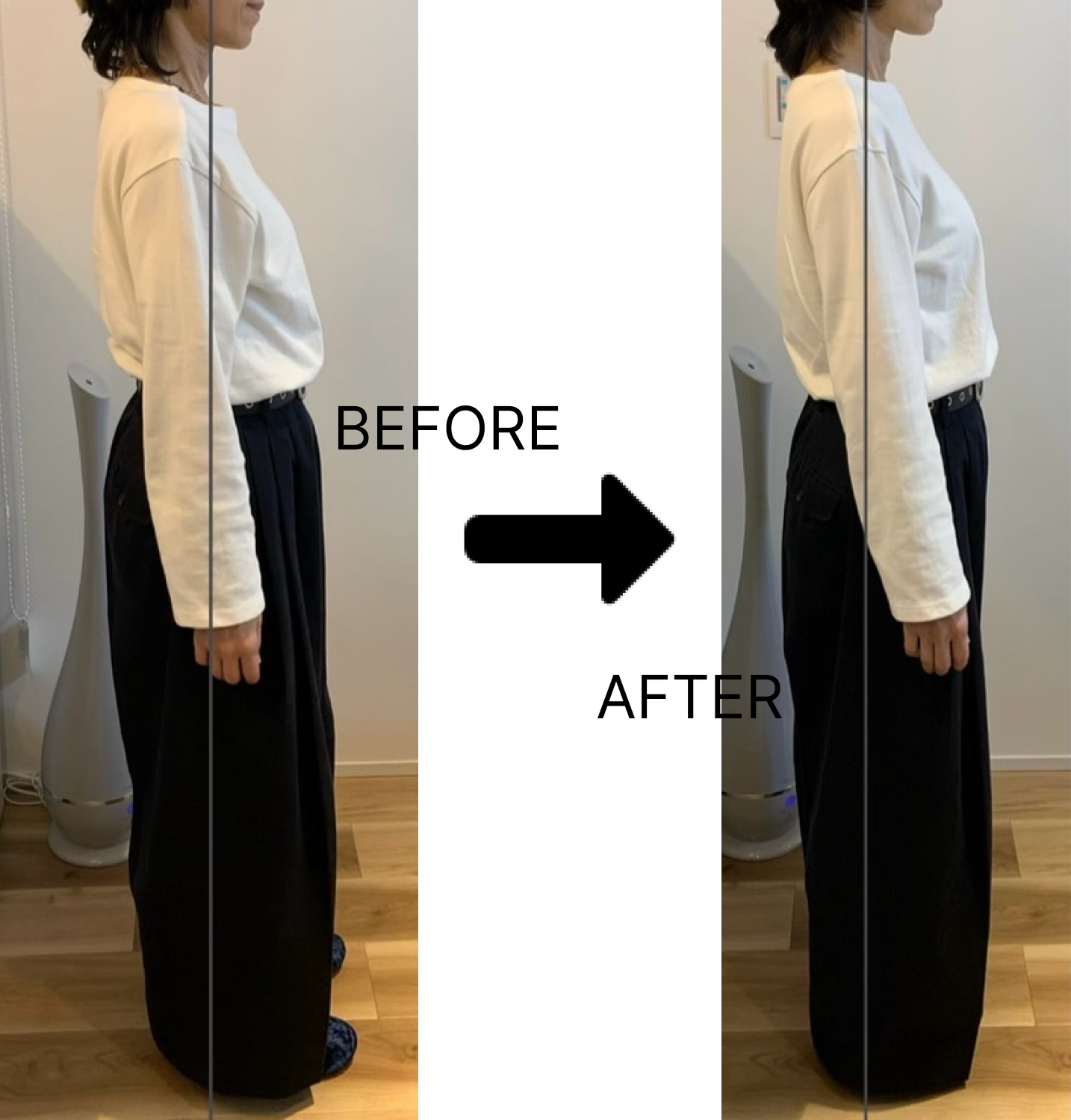 Before After フェムケア矯正の施術前後の写真(横)