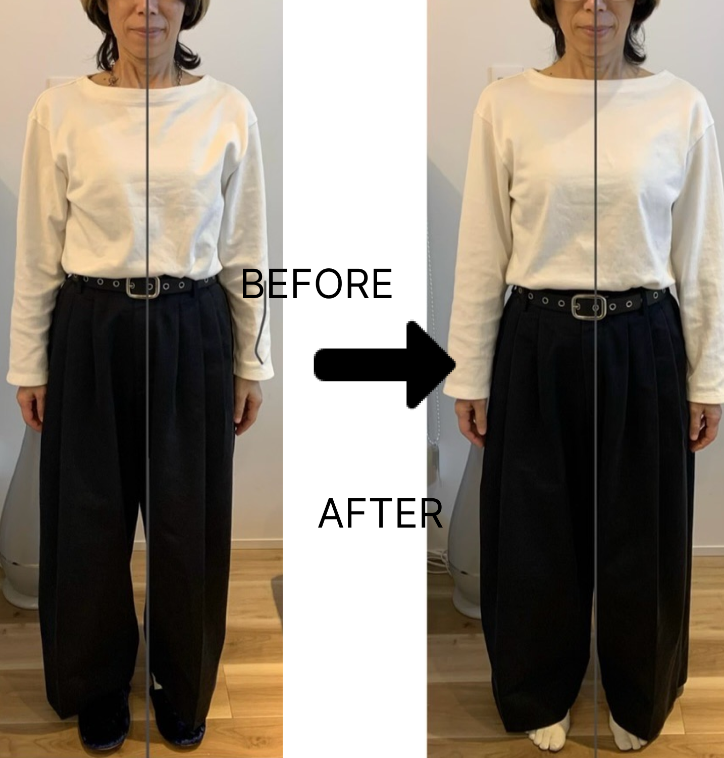 Before After フェムケア矯正の施術前後の写真(正面)