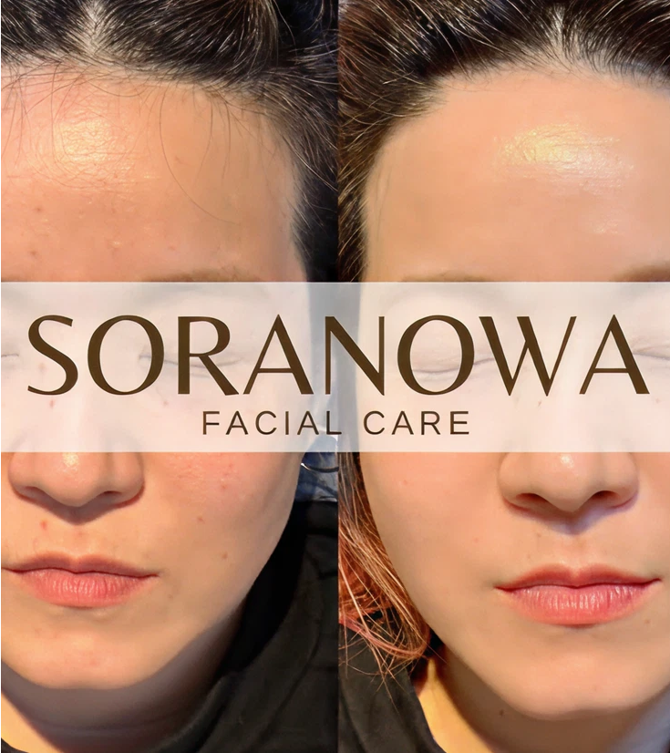 ミコステラフェイシャルケアの施術前後の写真