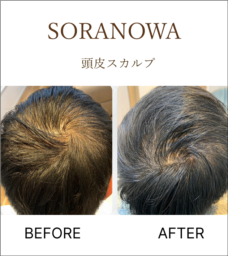 ミコステラ頭皮スカルプケアの施術前後の写真