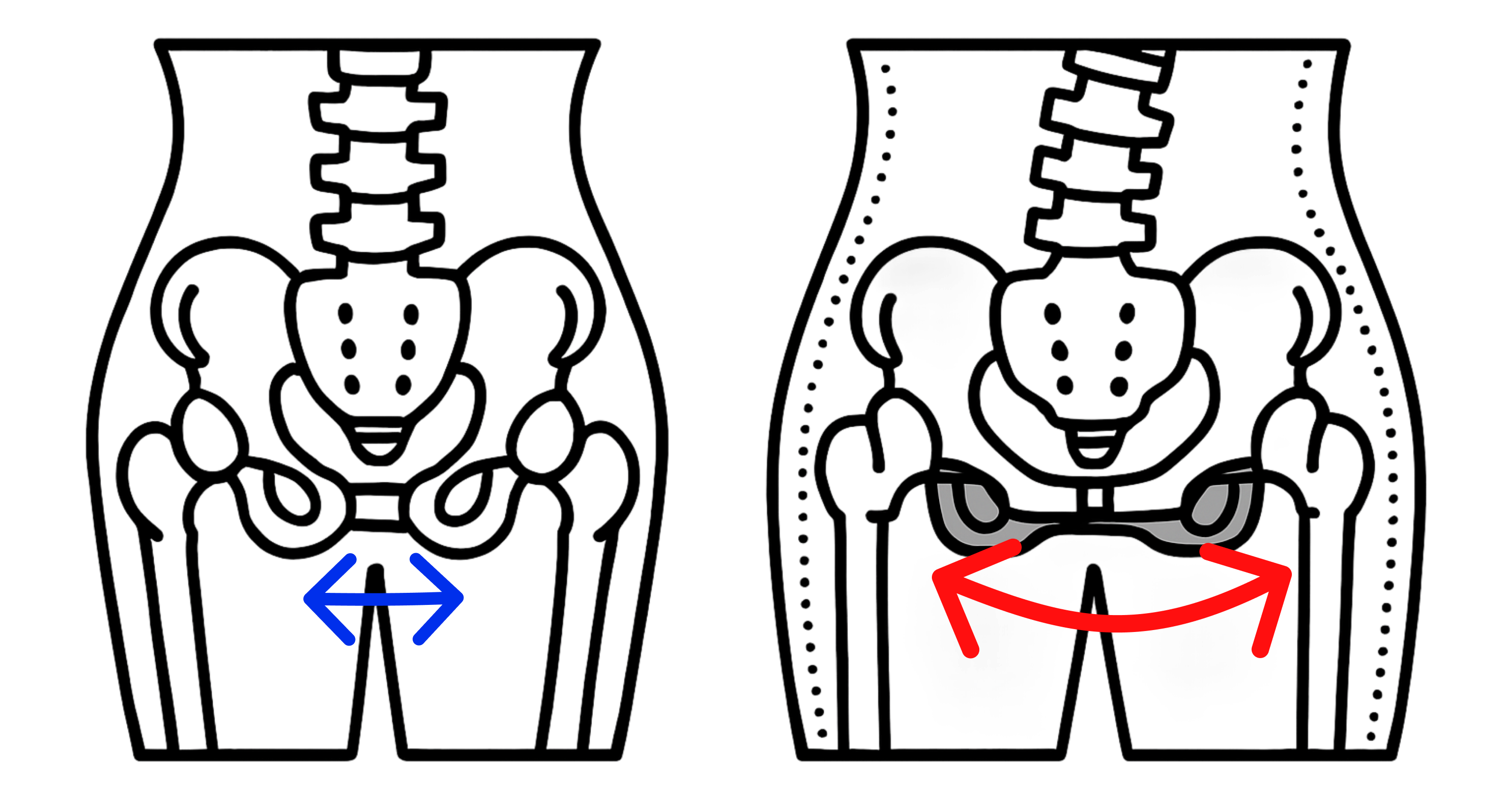 骨盤の開き・歪みの骨格イラスト
